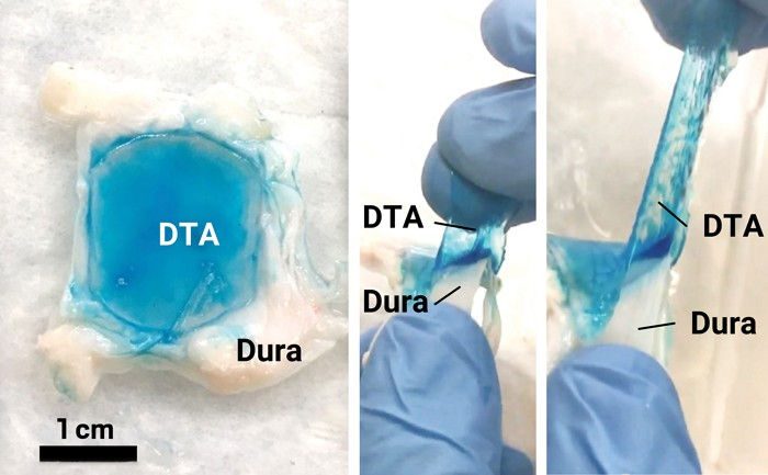 On the left side of the image, a blue gel patch is surrounded by white tissue; on the right two panels, gloved hands peel the stretchy gel off the tissue.